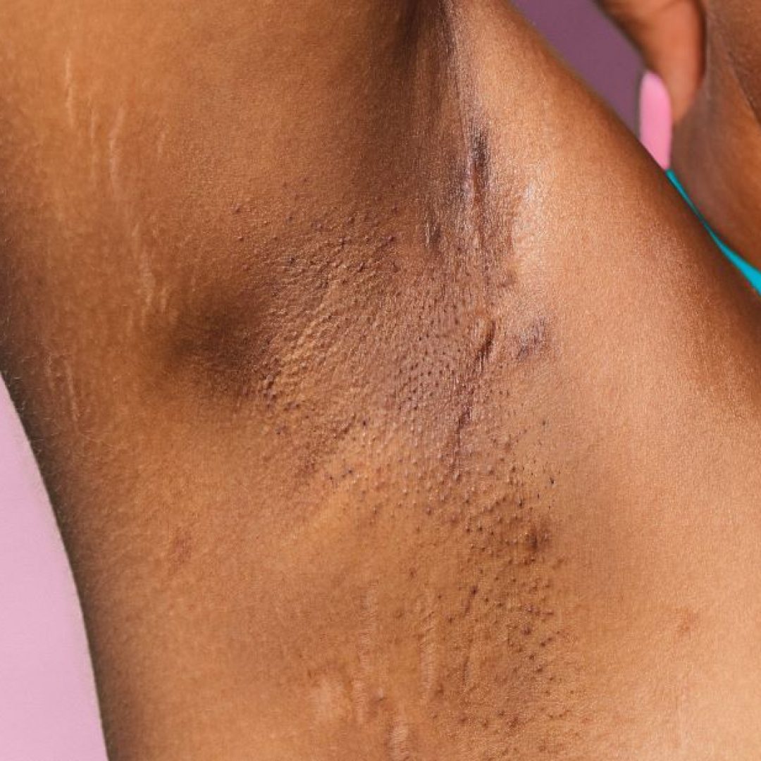 how_to_get_rid_of_dark_underarms_d9bf8901-1db4-4596-8d95-b798575533d7